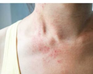 बदलते मौसम में क्यों बढ़ जाते हैं स्किन&hellip;