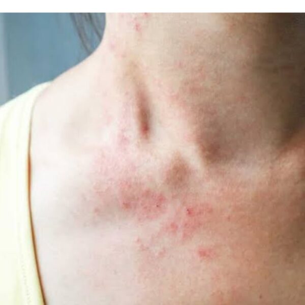 बदलते मौसम में क्यों बढ़ जाते हैं स्किन&hellip;